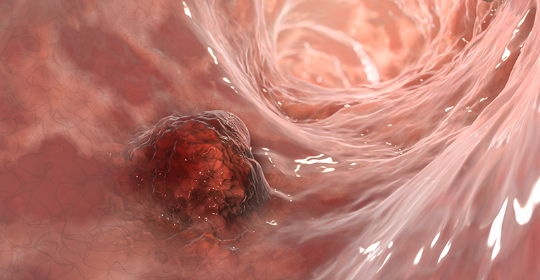 3D illustration of intestinal carcinoma © iStock/Dr_Microbe